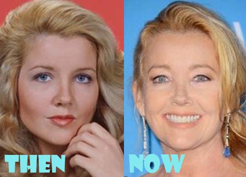 Melody Thomas Scott Plastic Surgery Before and After Facelift