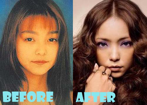 Namie Amuro Plastic Surgery Before and After Nose Job, Eyelid Surgery