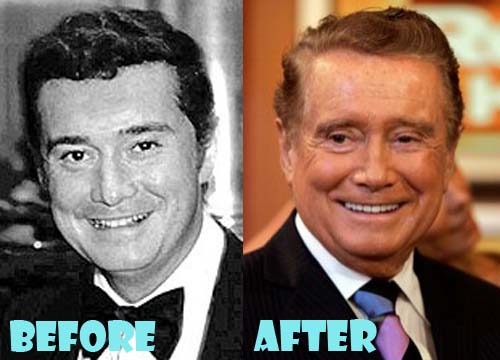 Regis Philbin Plastic Surgery Before and After Pictures