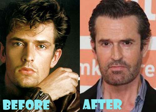 Rupert Everett Plastic Surgery Before and After Nose Job, Facelift