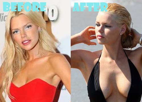 Sophie Monk Plastic Surgery Before and After Photos