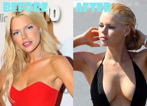 Sophie Monk Plastic Surgery Breast Implant