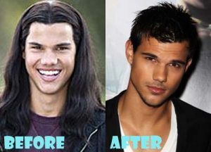 Taylor Lautner Plastic Surgery