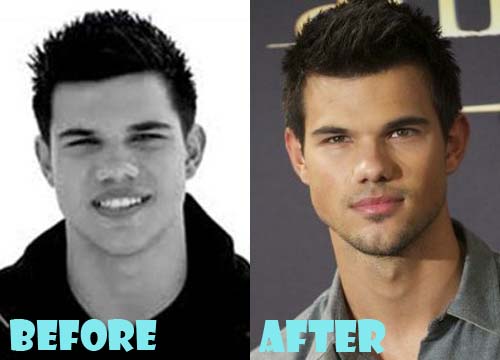 Taylor Lautner Plastic Surgery Before and After Nose Job