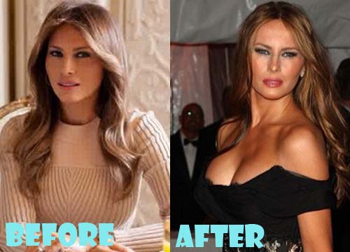 Melania Trump Plastic Surgery Breast Implant