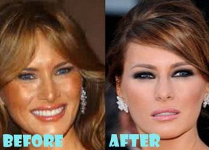 Melania Trump Plastic Surgery Nose Job