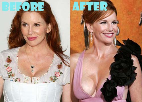 Melissa Gilbert Plastic Surgery Breast Implant