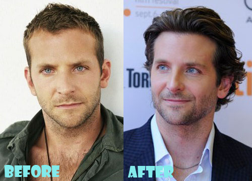 Bradley Cooper Plastic Surgery Before and After Pictures