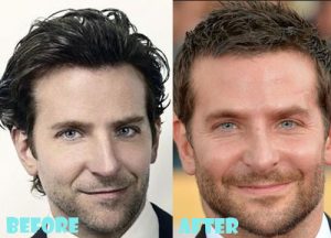 Bradley Cooper Plastic Surgery Nose Job
