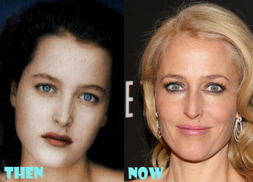 Gillian Anderson Plastic Surgery Botox, Facelift