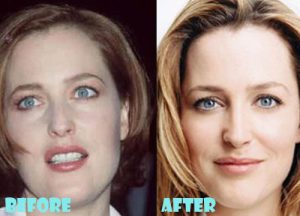 Gillian Anderson Plastic Surgery Nose Job