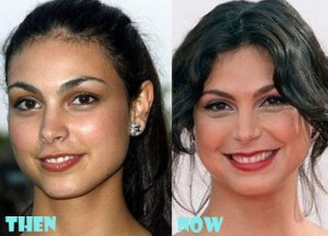Morena Baccarin Plastic Surgery Botox, Facelift