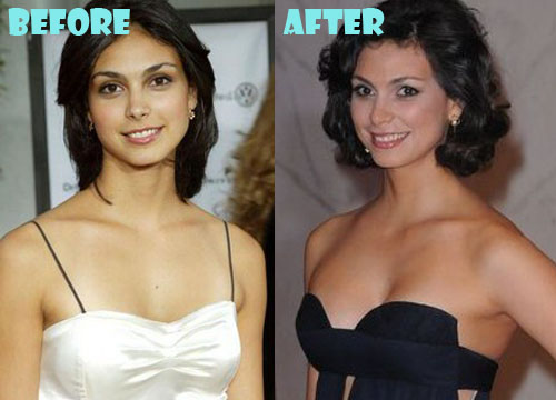 Morena Baccarin Plastic Surgery Breast Implant