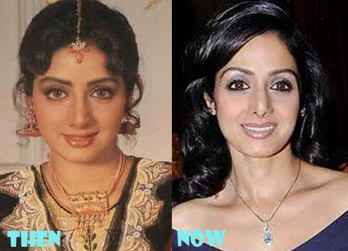 Sridevi Plastic Surgery Botox, Liposuction