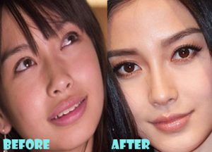 Angelababy Plastic Surgery Nose Job