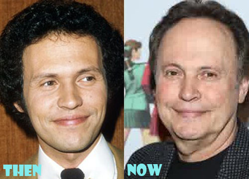 Billy Crystal Plastic Surgery Before After Pictures