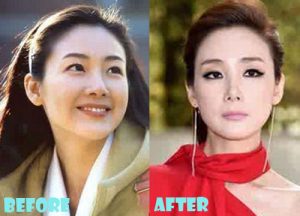 Choi Ji Woo Plastic Surgery Eyelid Surgery