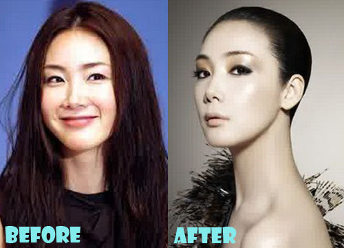 Choi Ji Woo Plastic Surgery Before and After Photos