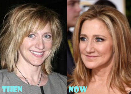 Edie Falco Plastic Surgery Before and After Photos