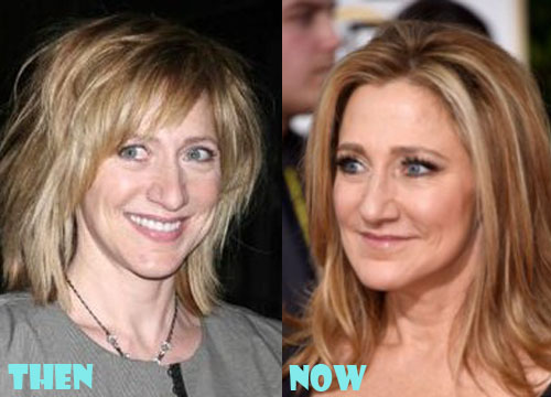 Edie Falco Plastic Surgery Botox