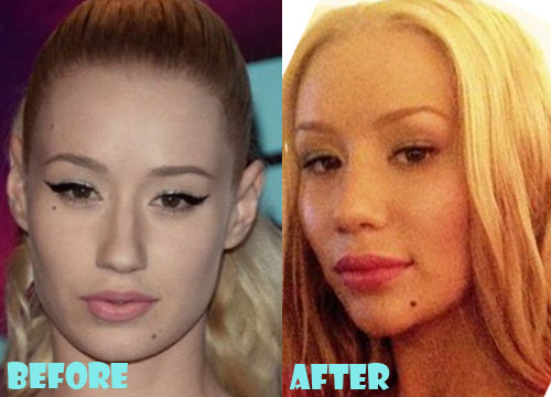 Iggy Azalea Plastic Surgery Lip & Chin Implant