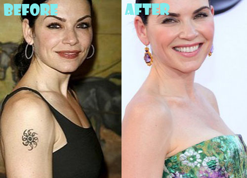 Julianna Margulies Plastic Surgery Boob Job