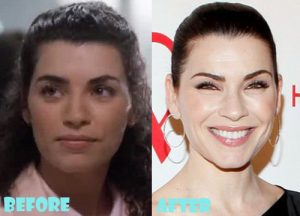 Julianna Margulies Plastic Surgery Nose Job