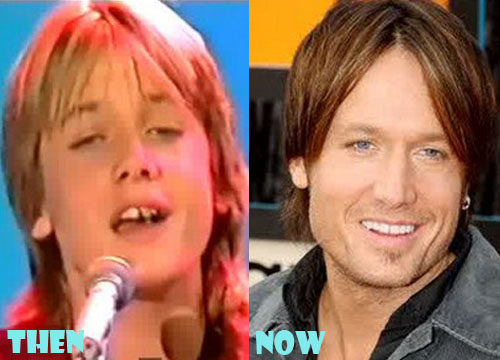 Keith Urban Plastic Surgery Before and After Pictures