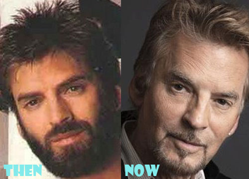 Kenny Loggins Bad Plastic Surgery