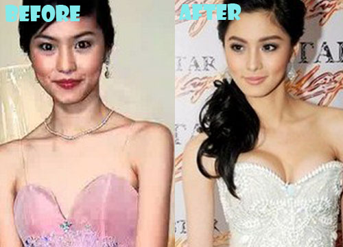 Kim Chiu Plastic Surgery Breast Implant