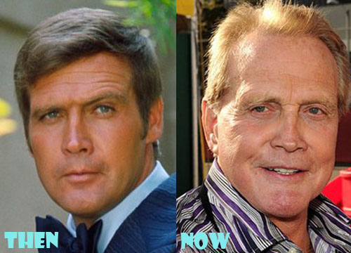 Lee Majors Plastic Surgery Before After Pictures