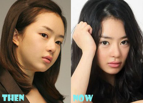 Seo Woo Plastic Surgery Before After Pictures