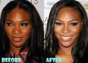 Serena Williams Plastic Surgery Nose Job