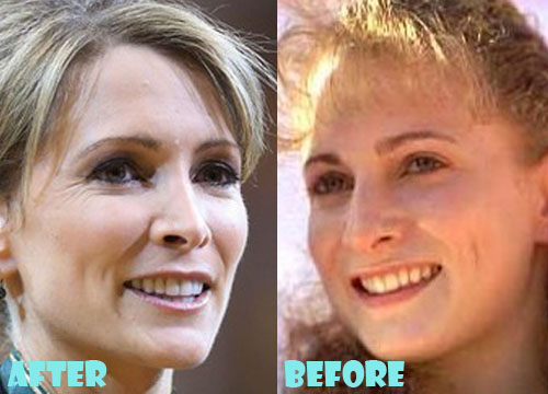 Shannon Miller Plastic Surgery Before and After Nose Job