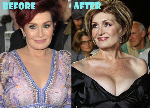 Sharon Osbourne Plastic Surgery Boob Job
