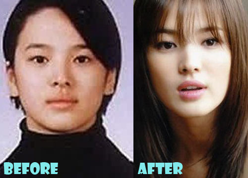 Song Hye Kyo Plastic Surgery Before and After Pictures