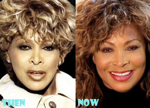Tina Turner Plastic Surgery Before and After Botox, Facelift