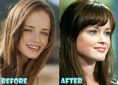 Alexis Bledel Plastic Surgery