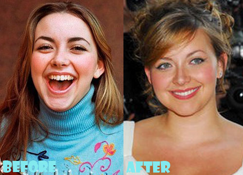 Charlotte Church Plastic Surgery Nose Job