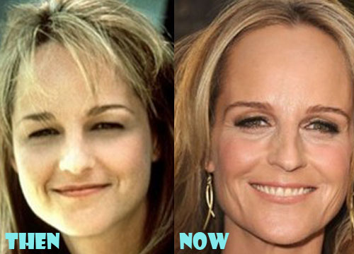 Helen Hunt Plastic Surgery Before and After Photo