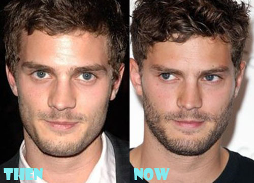 Jamie Dornan Plastic Surgery Before After Picture