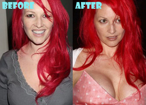 Jane Goldman Plastic Surgery Breast Implant