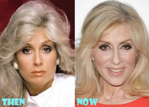 Judith Light Plastic Surgery