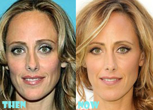 Kim Raver Plastic Surgery Botox