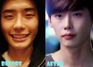 Lee Jong Suk Plastic Surgery