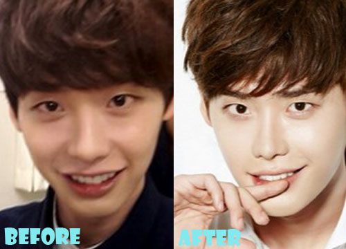 Lee Jong Suk Plastic Surgery Nose Job