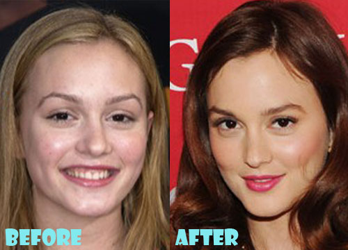 Leighton Meester Plastic Surgery Before After Nose Job