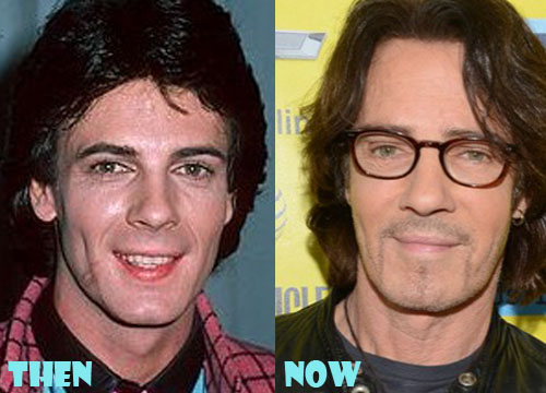Rick Springfield Plastic Surgery Before and After Photos