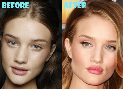 Rosie Huntington-Whiteley Plastic Surgery Before After