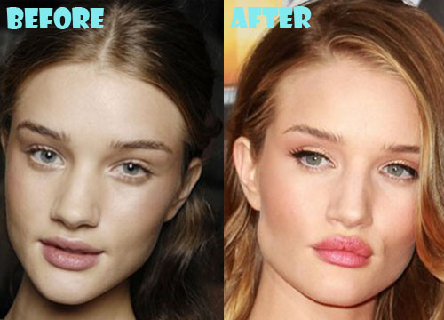 Rosie Huntington-Whiteley Plastic Surgery Lip Implant